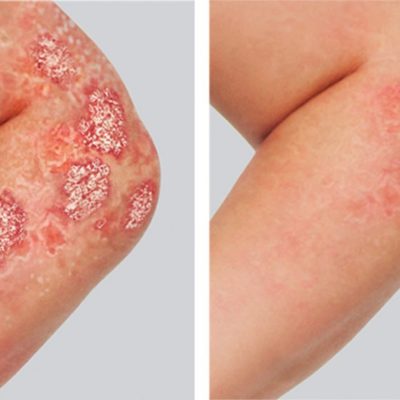 before-after-psoriasis